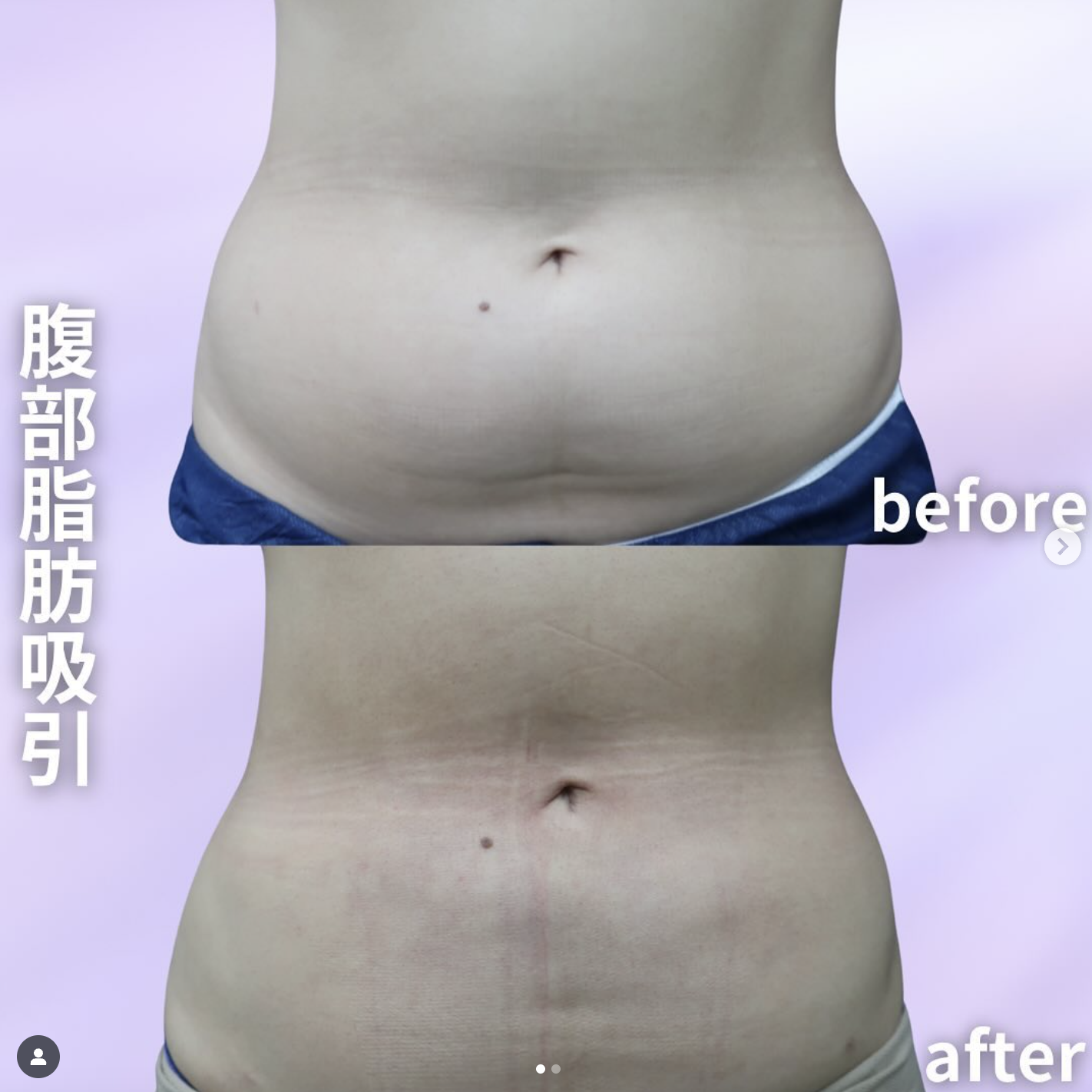 腹部