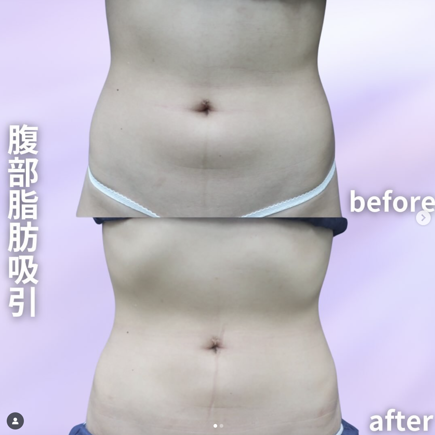 腹部
