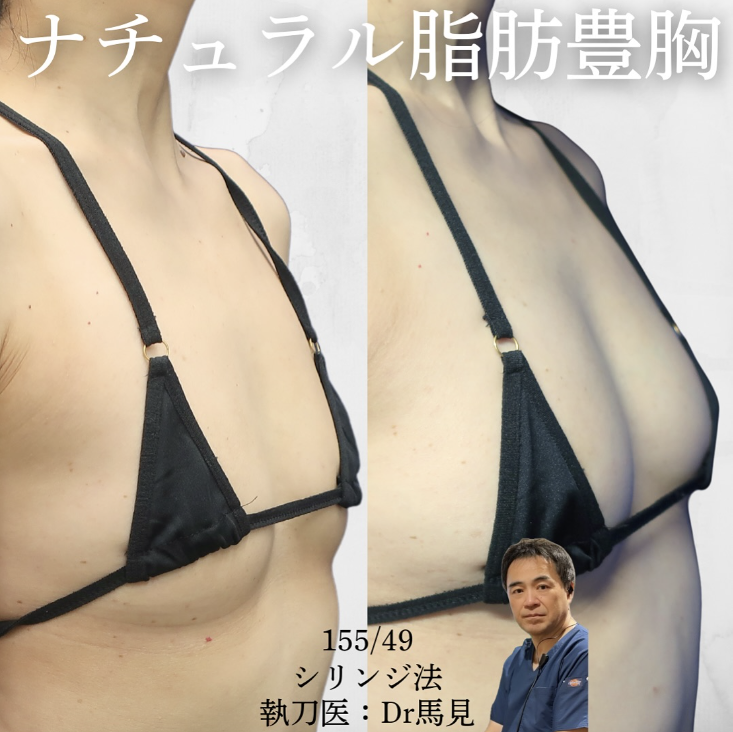 ナチュラル脂肪豊胸（脂肪注入＋脂肪吸引)
