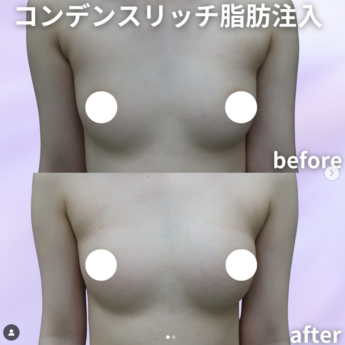 脂肪注入＋脂肪吸引(必要量のみ)