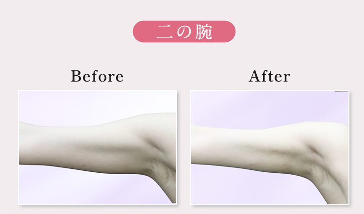 二の腕